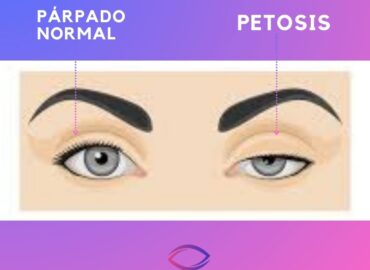 ¿Qué es la ptosis y cómo afecta su salud visual?